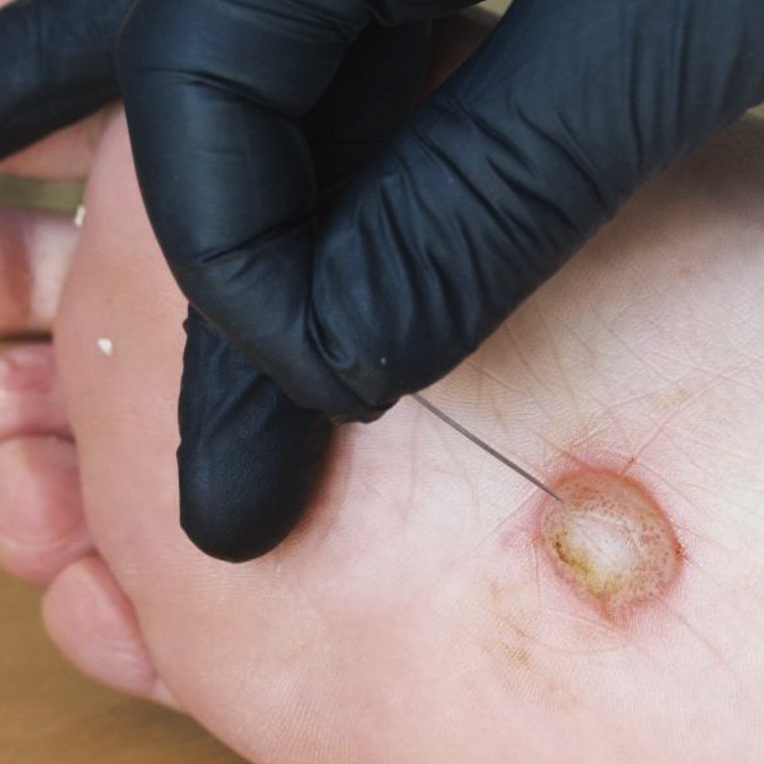 Diabetic foot ulcer on the sole of the foot.